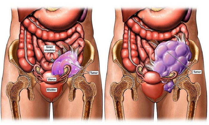 RAHİM AĞZI KANSERİ AŞISI