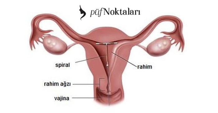 RAHİM İÇİ ARAÇ ( RIA , SPİRAL)