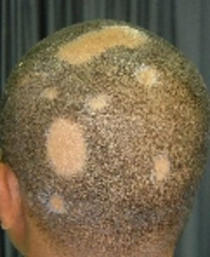 Saçkıran (alopesi areata)