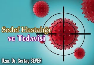 Sedef hastalığı (psoriazis) ve tedavisi