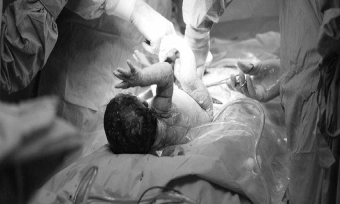 SEZARYEN İLE DOĞUM