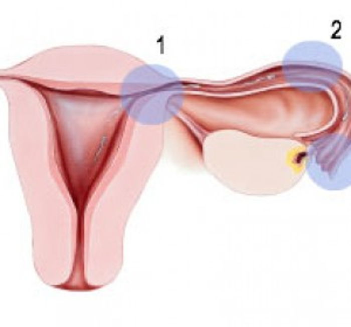 TÜPLERİN TIKALI OLMASI