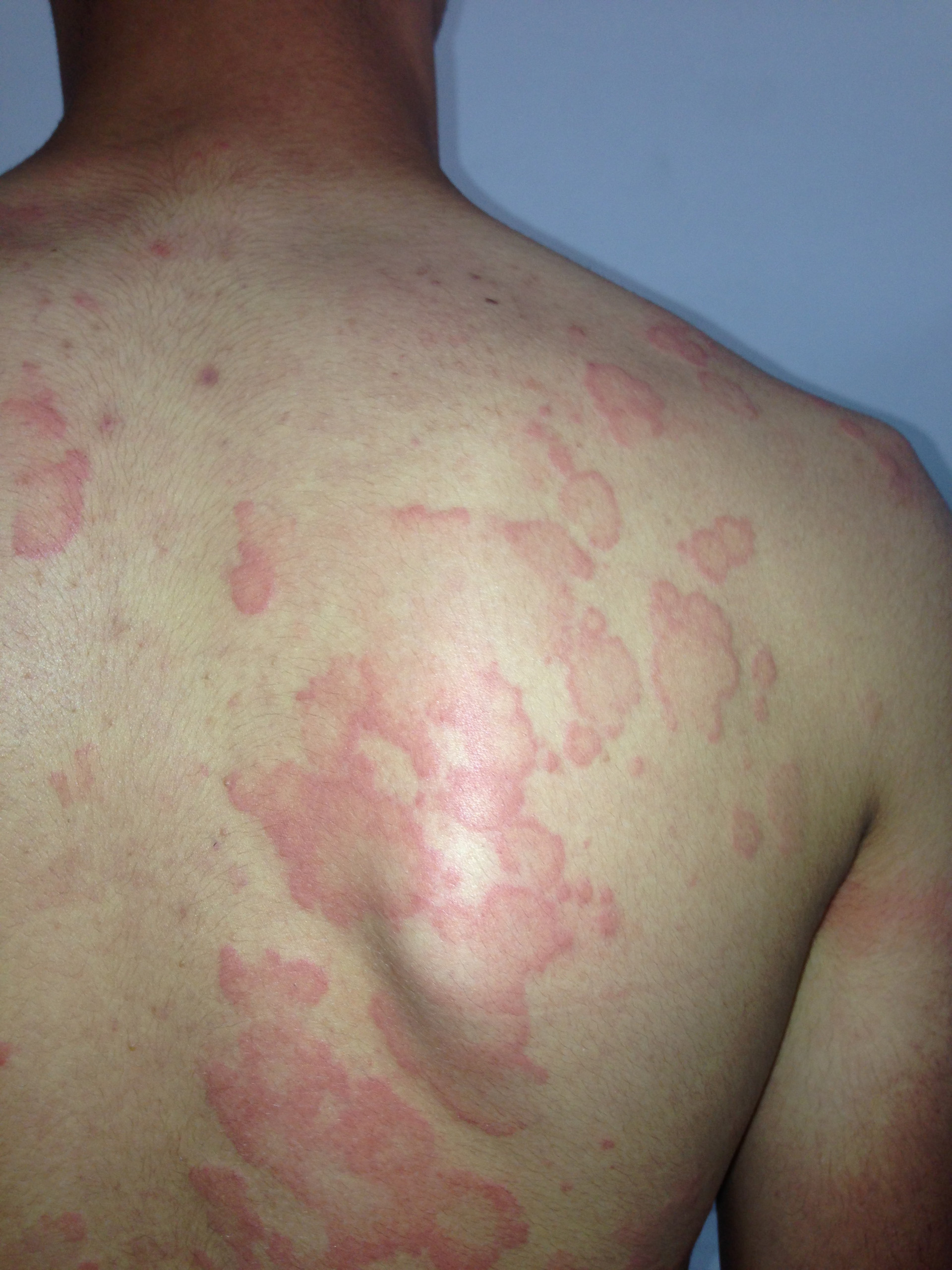 Ürtiker ve anjiyoödem