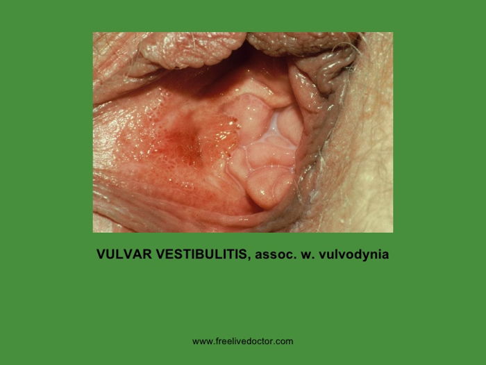 VULVAR VESTİBÜLİT SENDROMU