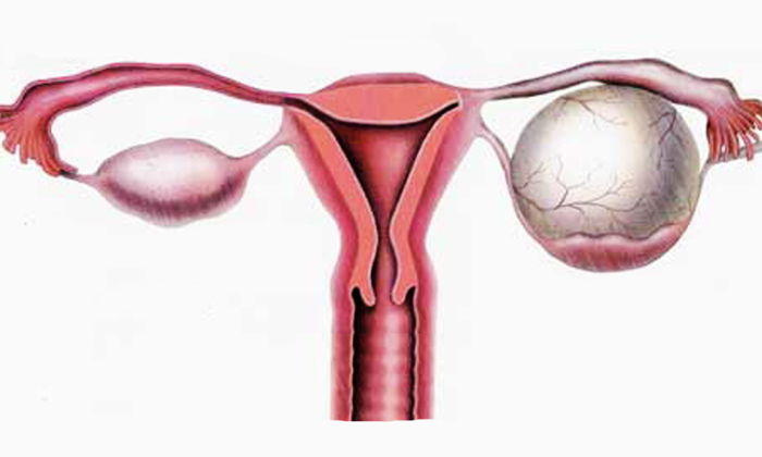 Yumurtalık Kistlerinden Kapalı Cerrahiyle Kurtulmak Mümkün